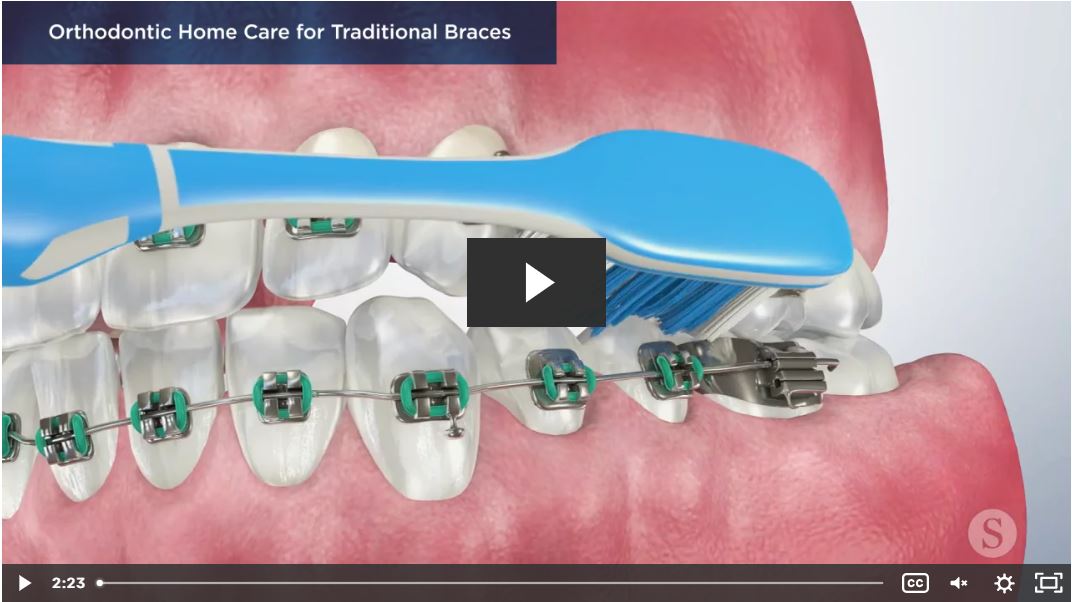 Orthodontic Home Care for Traditional Braces